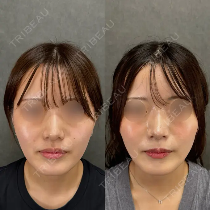 鼻尖形成（切開） ネビュラクリニック 京都院 DAY 124 メイン用