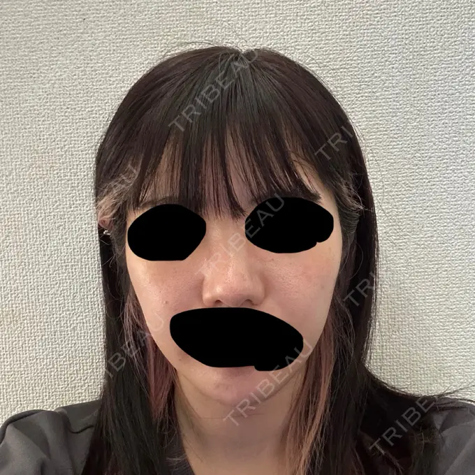 ヒアルロン酸注入（頬） THE FIRST CLINIC 町田院 DAY 3 メイン用