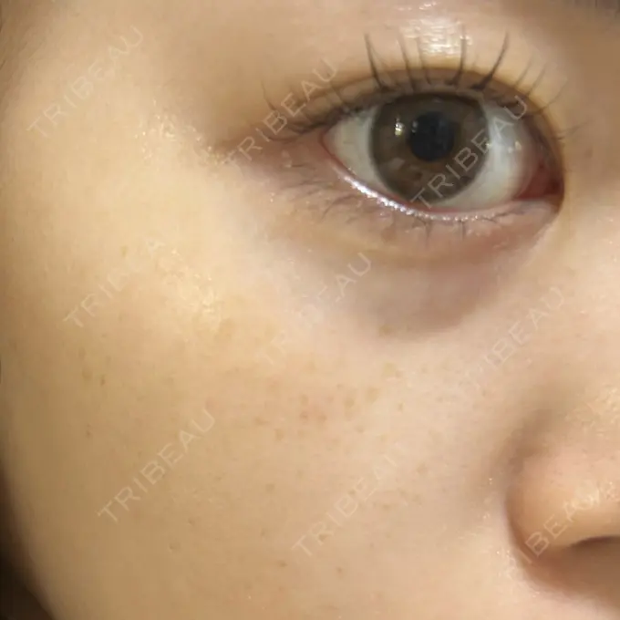 ルメッカ ゆきスキンクリニック 東池袋 AFTER メイン用