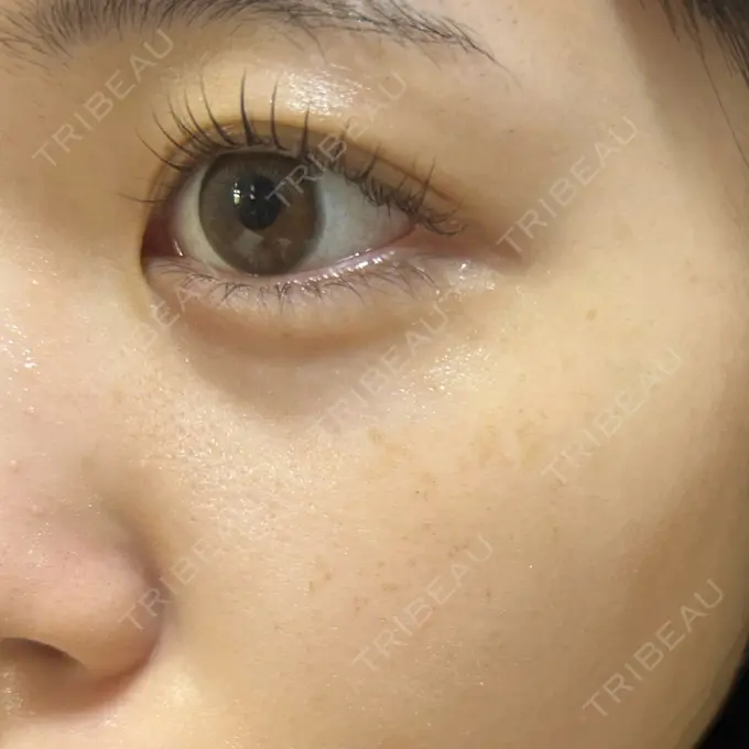 ルメッカ ゆきスキンクリニック 東池袋 DAY 8 メイン用