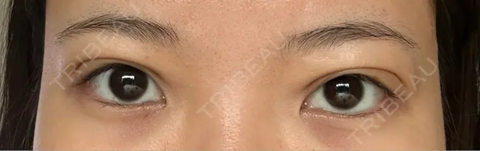 二重埋没 Brandnew Beauty Clinic DAY 3 メイン用