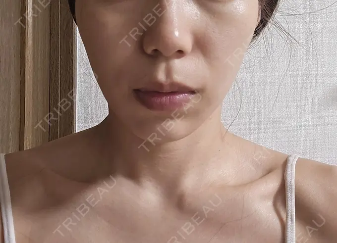 ハイフ（顔） 東京美容外科 福岡院 AFTER メイン用