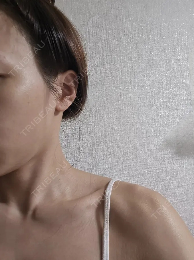 ボトックス（エラ・小顔） / ボトックス（肩） ヴァージンクリニック 福岡天神院 DAY 24 メイン用