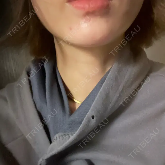 糸リフト / 脂肪吸引（顔） / ジョールファット除去 アリエル美容クリニック 横浜院 AFTER メイン用