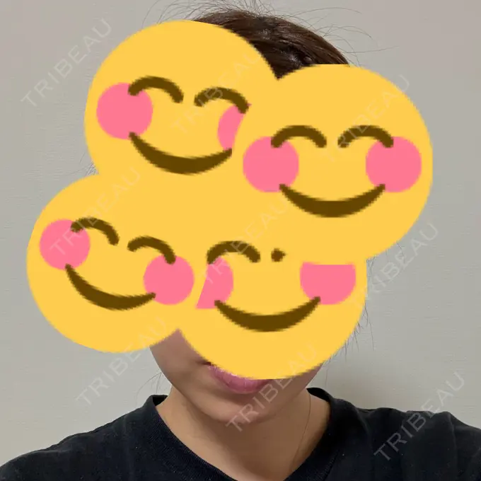 ヒアルロン酸溶解 EOL CLINIC【オルクリニック】 AFTER メイン用