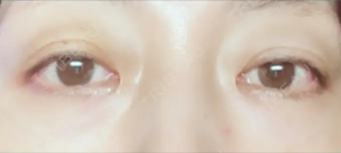 二重埋没 小倉美容外科ネビュラクリニック DAY 4 メイン用