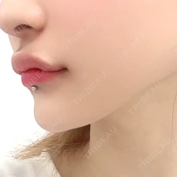 ボトックス（エラ・小顔） / ヒアルロン酸注入（唇） / ボトックス（口角） / ヒアルロン酸注入（目の下） / ポテンツァ TCB東京中央美容外科 水戸院 DAY 0 メイン用