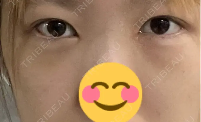 クマ治療 / ヒアルロン酸注入（目の下） BITO BEAUTY CLINIC DAY 8 メイン用