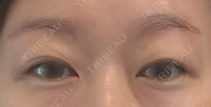 眉下切開 もとび美容外科クリニック 新宿院 DAY 15 メイン用