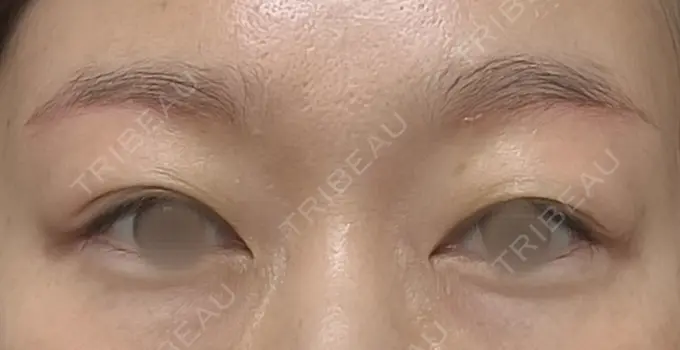 眉下切開 もとび美容外科クリニック 新宿院 AFTER メイン用