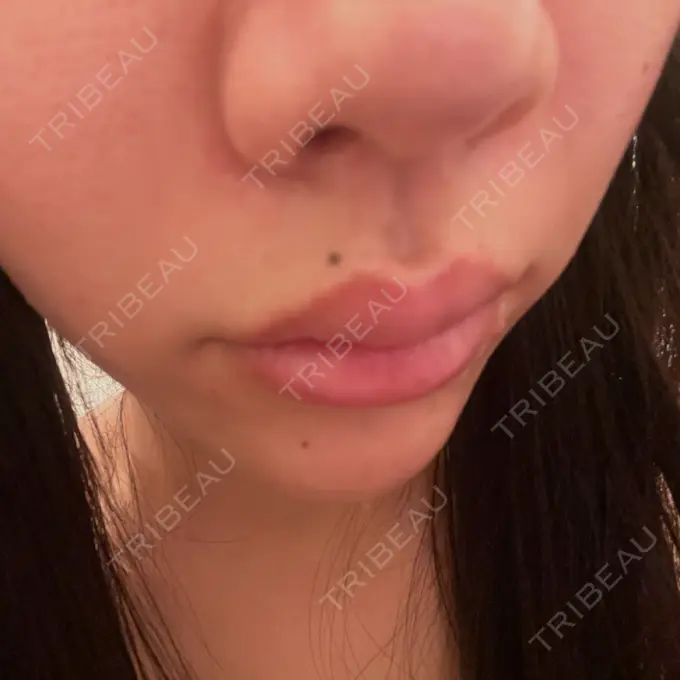 ヒアルロン酸注入（涙袋） / 肌ヒアルロン酸注入（たるみ・シワ改善） / ヒアルロン酸注入（唇） / ヒアルロン酸注入（目の下） 共立美容外科 神戸三宮院 DAY 0 メイン用