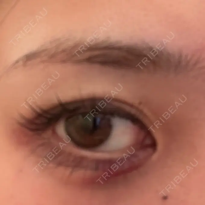 ヒアルロン酸注入（涙袋） / 肌ヒアルロン酸注入（たるみ・シワ改善） / ヒアルロン酸注入（唇） / ヒアルロン酸注入（目の下） 共立美容外科 神戸三宮院 DAY 0 メイン用