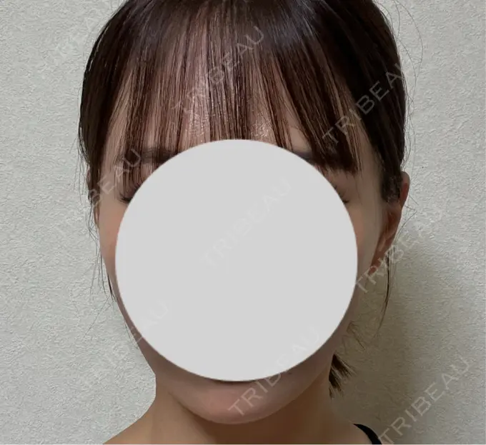 糸リフト / その他（肌） MAクリニック 心斎橋 DAY 40 メイン用