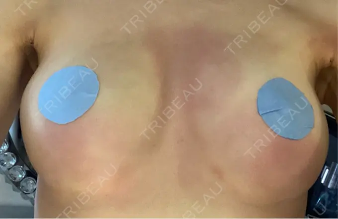 豊胸（脂肪注入） plume clinic DAY 1 メイン用