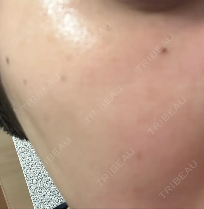 光治療（フォトフェイシャルなど） LiLAスキンクリニック中目黒 AFTER メイン用