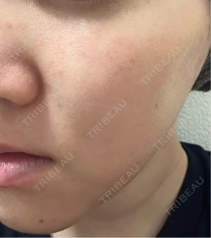 光治療（フォトフェイシャルなど） LiLAスキンクリニック中目黒 DAY 2 メイン用