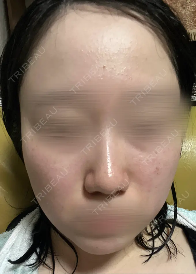 ルメッカ BITO BEAUTY CLINIC DAY 3 メイン用