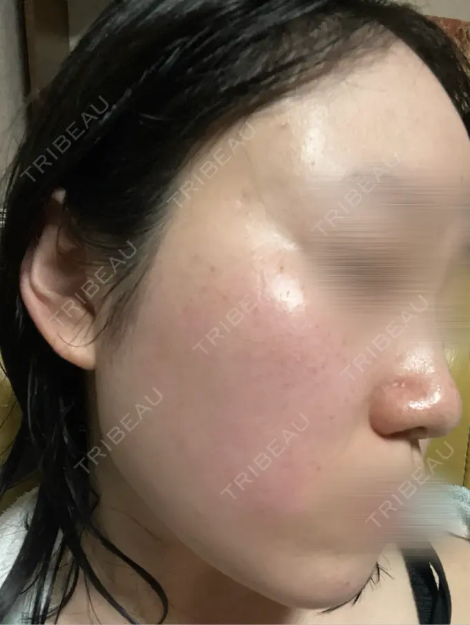 ルメッカ BITO BEAUTY CLINIC DAY 3 メイン用