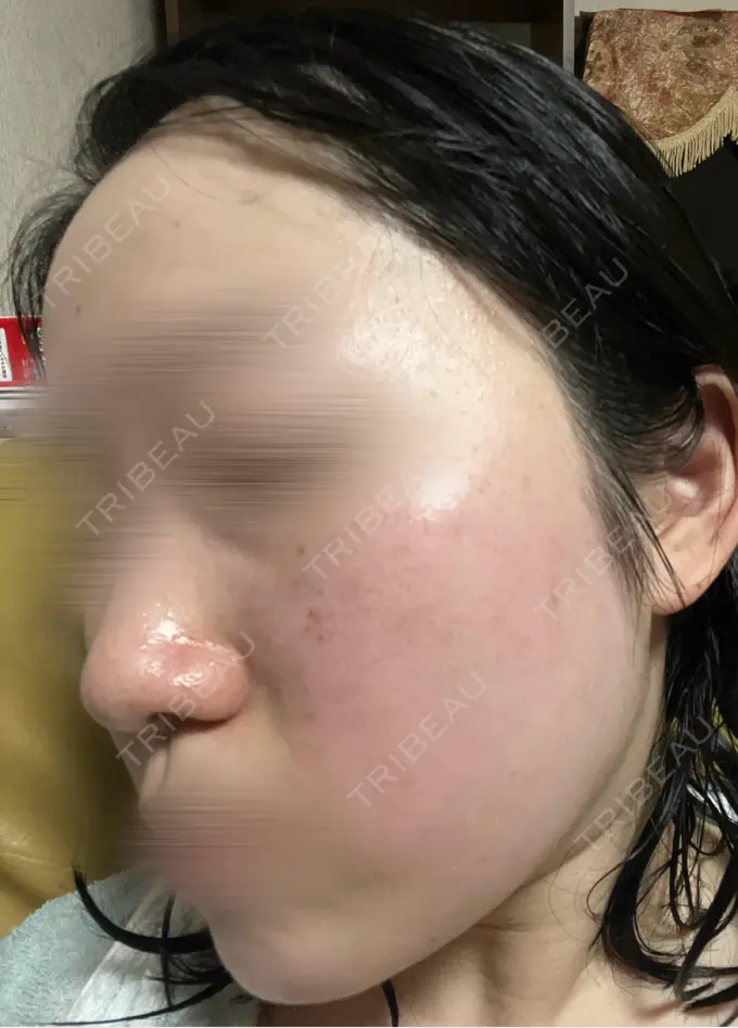 ルメッカ BITO BEAUTY CLINIC DAY 3 メイン用