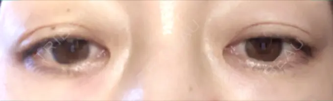 二重埋没 小倉美容外科ネビュラクリニック DAY 5 メイン用