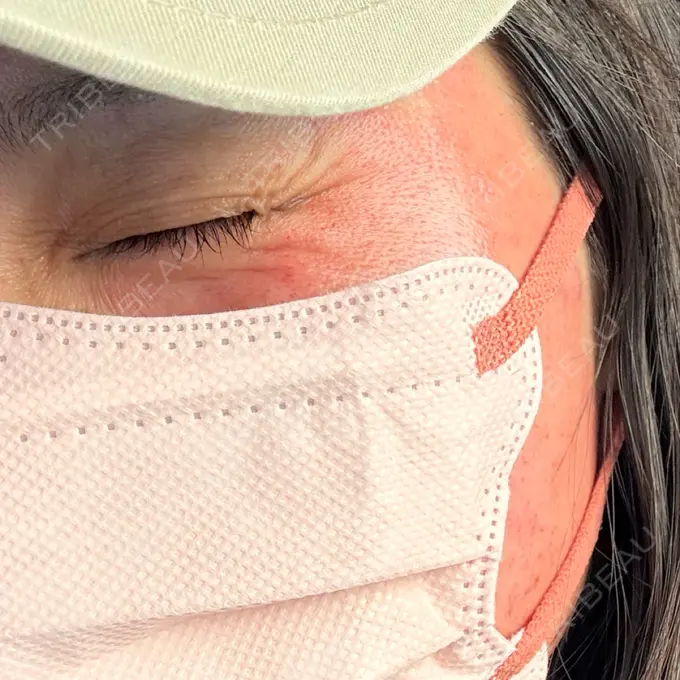 ピーリング（ニキビ・毛穴） / ピコレーザートーニング（美白・肝斑） / ピコフラクショナルレーザー（毛穴・ニキビ跡） ルラ美容クリニック 広島院 AFTER メイン用