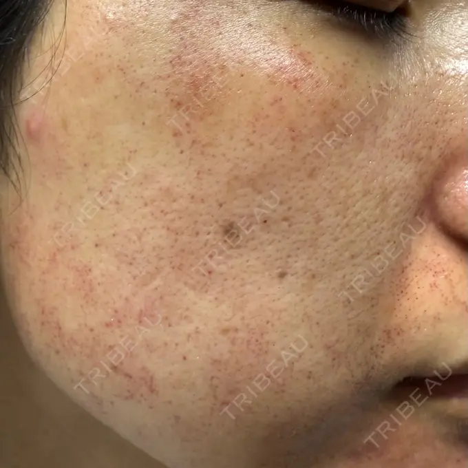 ピーリング（ニキビ・毛穴） / ピコレーザートーニング（美白・肝斑） / ピコフラクショナルレーザー（毛穴・ニキビ跡） ルラ美容クリニック 広島院 DAY 0 メイン用