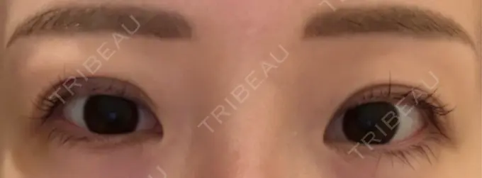 二重埋没 宇都宮竹内クリニック DAY 8 メイン用