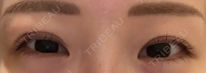 二重埋没 宇都宮竹内クリニック DAY 8 メイン用