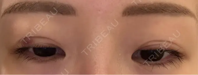 二重埋没 宇都宮竹内クリニック DAY 8 メイン用