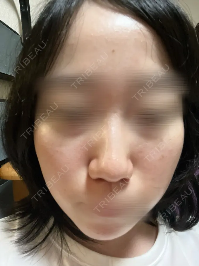 ルメッカ BITO BEAUTY CLINIC AFTER メイン用