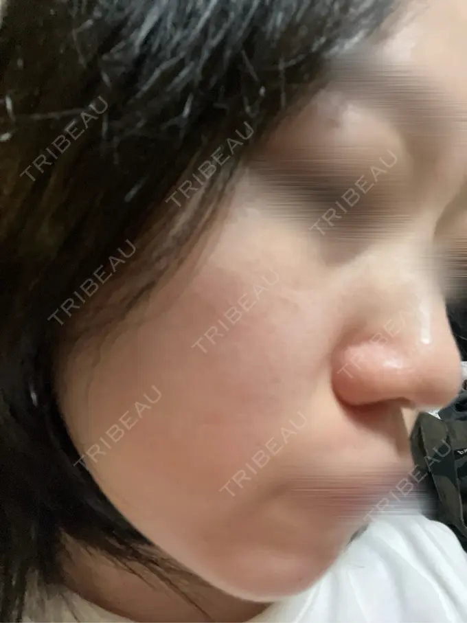 ルメッカ BITO BEAUTY CLINIC DAY 5 メイン用