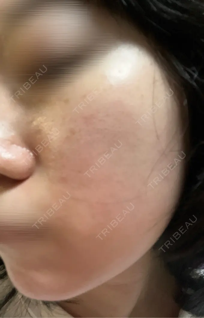 ルメッカ BITO BEAUTY CLINIC DAY 5 メイン用