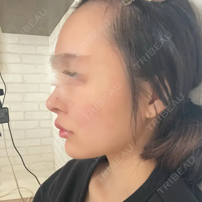 ほくろ・いぼ切除（肌） / ヒアルロン酸注入（あご） NARU Beauty Clinic 【ナルクリ】 水戸院 DAY 4 メイン用