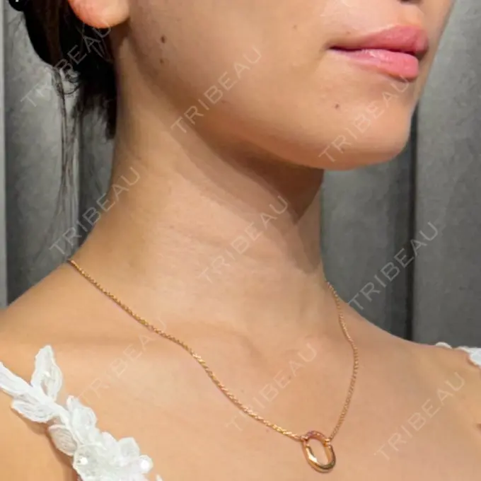 インディバ（顔） WOM SALON【術後ケア取扱いサロン】 DAY 0 メイン用