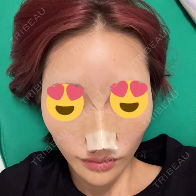 鼻尖形成（切開） / 軟骨移植 表参道ウィズ・クリニック DAY 0 メイン用