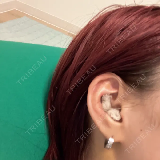 鼻尖形成（切開） / 軟骨移植 表参道ウィズ・クリニック DAY 3 メイン用