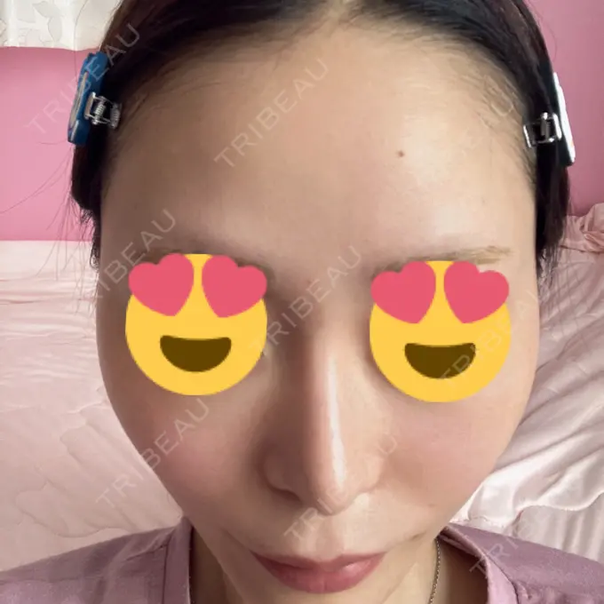 鼻尖形成（切開） / 軟骨移植 表参道ウィズ・クリニック AFTER メイン用