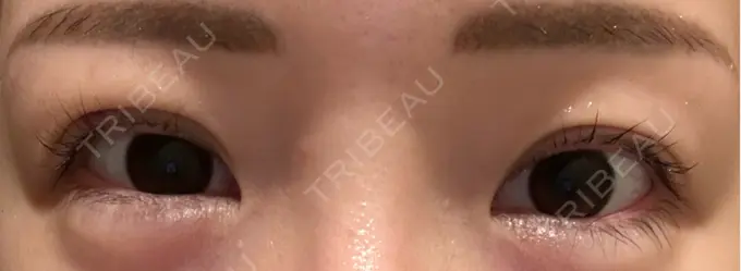 二重埋没 宇都宮竹内クリニック DAY 9 メイン用