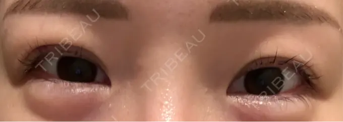 二重埋没 宇都宮竹内クリニック DAY 9 メイン用