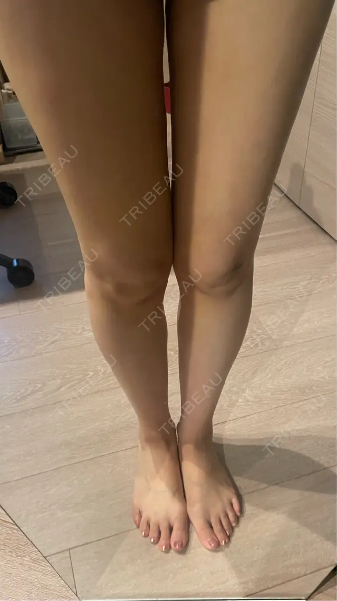 脂肪吸引（顔） / 脂肪吸引（二の腕） / 脂肪吸引（脚） / 脂肪吸引（お腹） / 脂肪吸引（お尻） / 豊胸（脂肪注入） / 脂肪吸引（腰） / 脂肪吸引（背中） / 脂肪吸引（肩） ヴェルトラクリニック 新宿院 DAY 7 メイン用