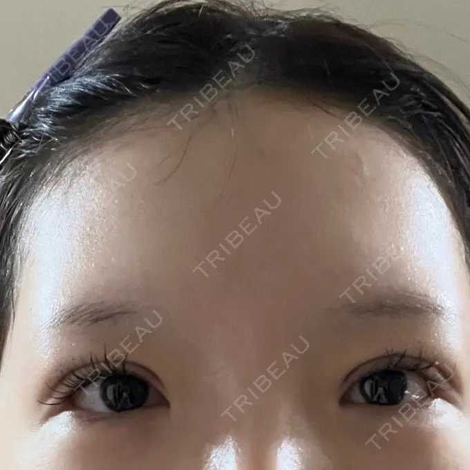 二重切開 / 眼瞼下垂（切開） / 目尻切開 / 上まぶたたるみ取り / 眼瞼下垂（非切開） / その他（目元） WOM CLINIC GINZA （ワム クリニック ギンザ） DAY 39 メイン用