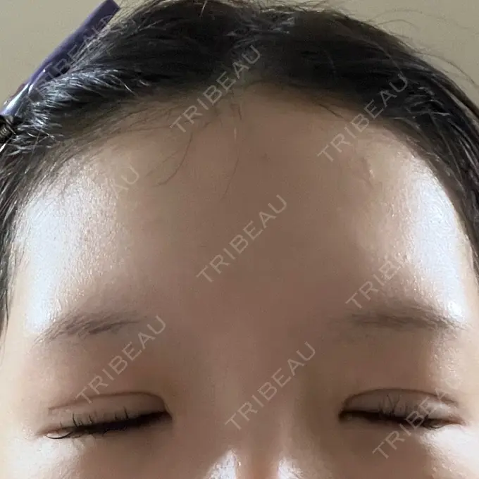 二重切開 / 眼瞼下垂（切開） / 目尻切開 / 上まぶたたるみ取り / 眼瞼下垂（非切開） / その他（目元） WOM CLINIC GINZA （ワム クリニック ギンザ） DAY 39 メイン用