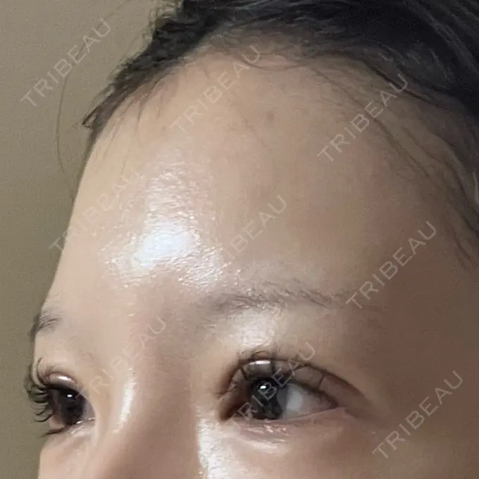 二重切開 / 眼瞼下垂（切開） / 目尻切開 / 上まぶたたるみ取り / 眼瞼下垂（非切開） / その他（目元） WOM CLINIC GINZA （ワム クリニック ギンザ） DAY 39 メイン用