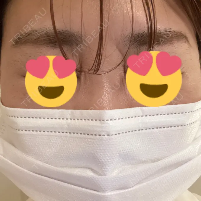 シワ取りボトックス / ボトックス（眉間） 銀座美容外科クリニック 銀座院 AFTER メイン用