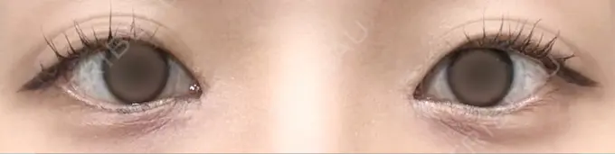 目頭切開 PRISM Beauty Clinic 町田院 AFTER メイン用