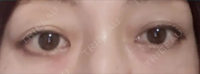 二重埋没 小倉美容外科ネビュラクリニック AFTER メイン用