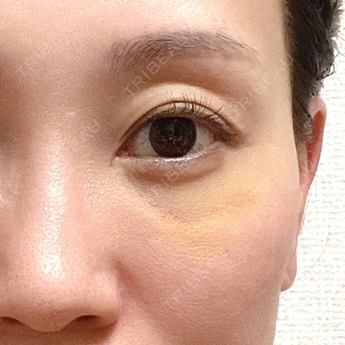 肌ヒアルロン酸注入（たるみ・シワ改善） しのぶ皮膚科 DAY 9 メイン用