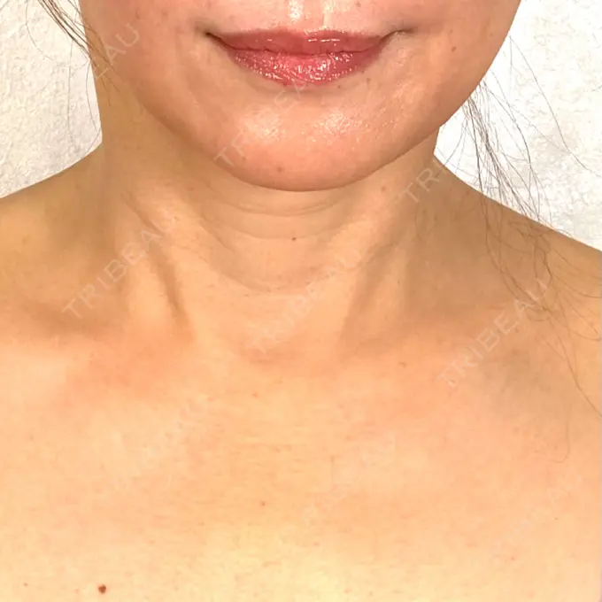 糸リフト / 肌ヒアルロン酸注入（たるみ・シワ改善） アリエル美容クリニック 横浜院 AFTER メイン用