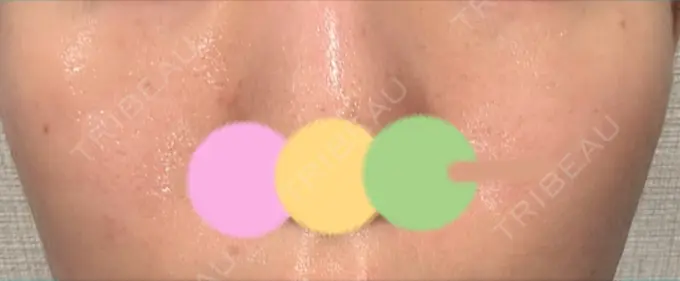 その他（肌） シンデレラ＆ダヴィンチクリニック DAY 5 メイン用