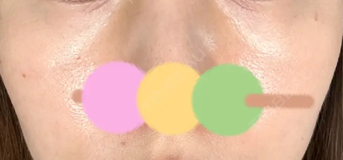 その他（肌） シンデレラ＆ダヴィンチクリニック DAY 11 メイン用